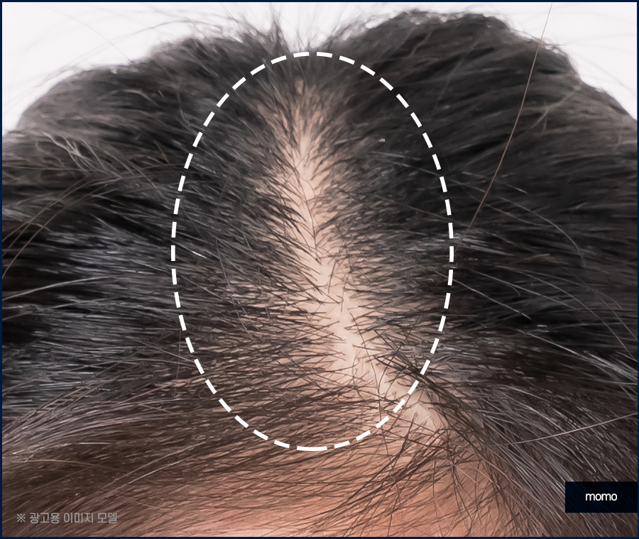 여자m자탈모 헤어라인 디자인까지 고려해 채우는 관련 이미지 5