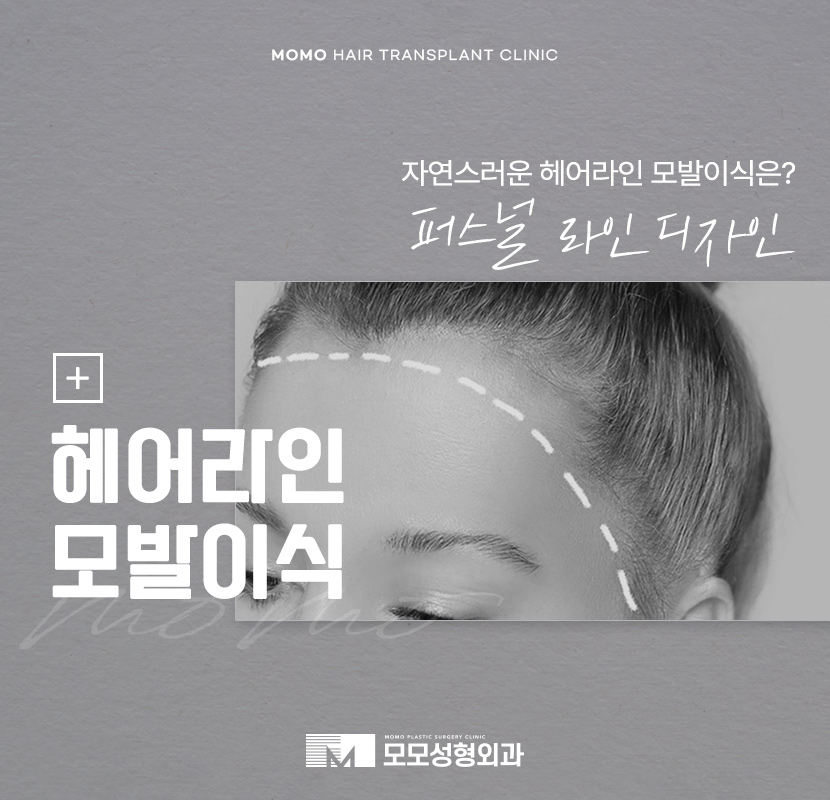 남자헤어라인모발이식 디자인의 중요성 관련 이미지 1