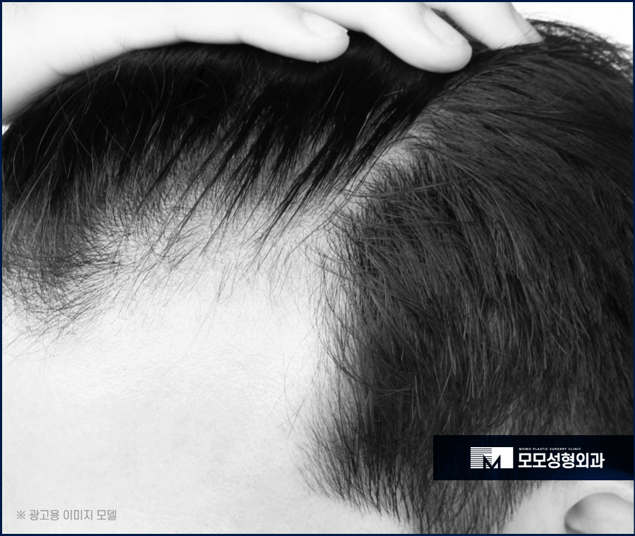 엠자탈모모발이식 안정적인 과정으로 나아가며 관련 이미지 4