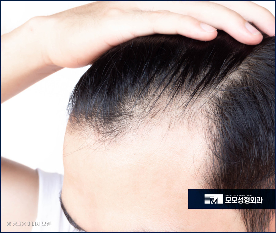 전두부탈모 원인과 보강하기 위한 방안 관련 이미지 3