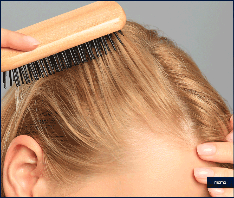 여자 측두부 탈모 아름다운 옆모습을 만드는 방법 관련 이미지 11