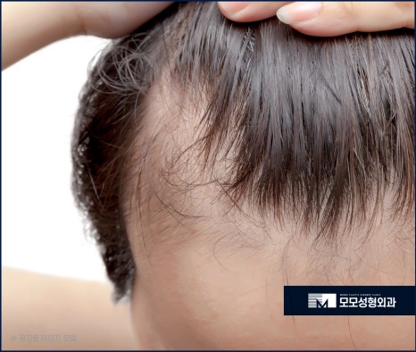 남자머리심기 신속한 일상 회복을 위한 방법 (ft. 비절개모발이식) 관련 이미지 9