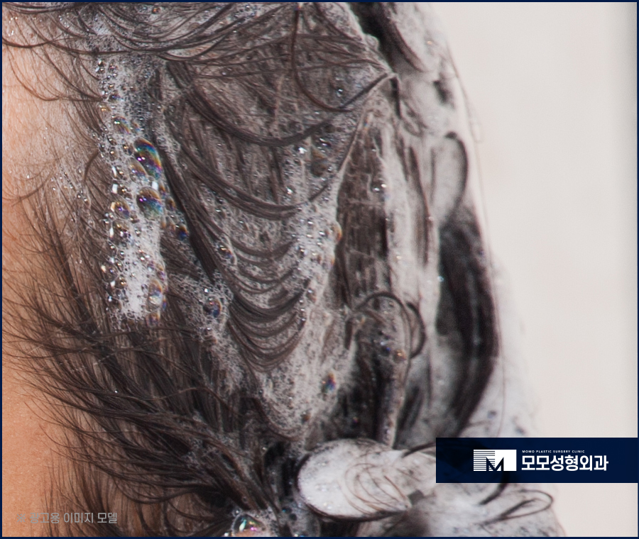 모발이식회복기간 및 반드시 알고 있어야 할 점 관련 이미지 4