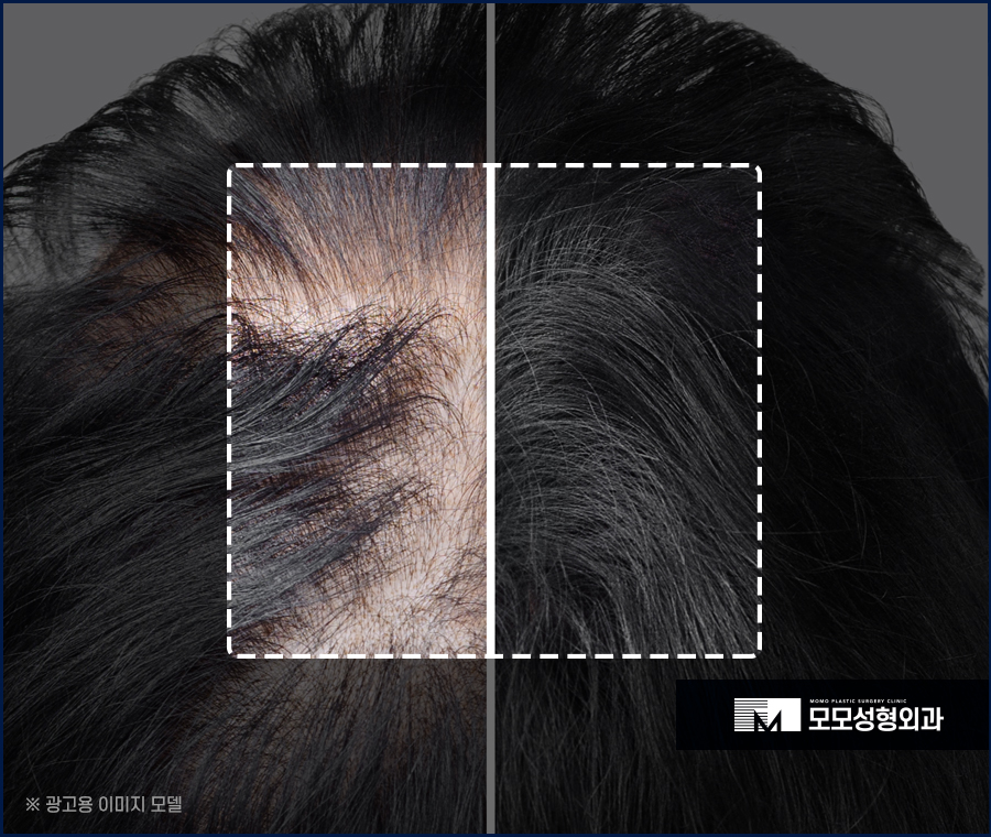 모발이식 삭발이 싫다면 노컷으로 부담을 줄여서 관련 이미지 5