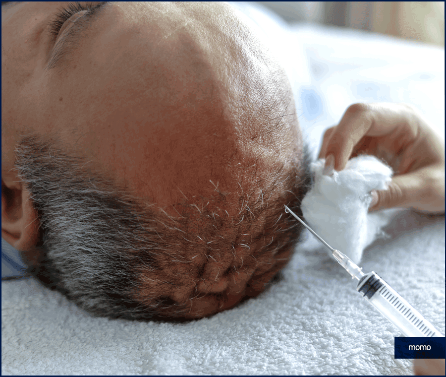 서울 탈모 성지 풍성함을 만들기 위한 방법 2가지 관련 이미지 8