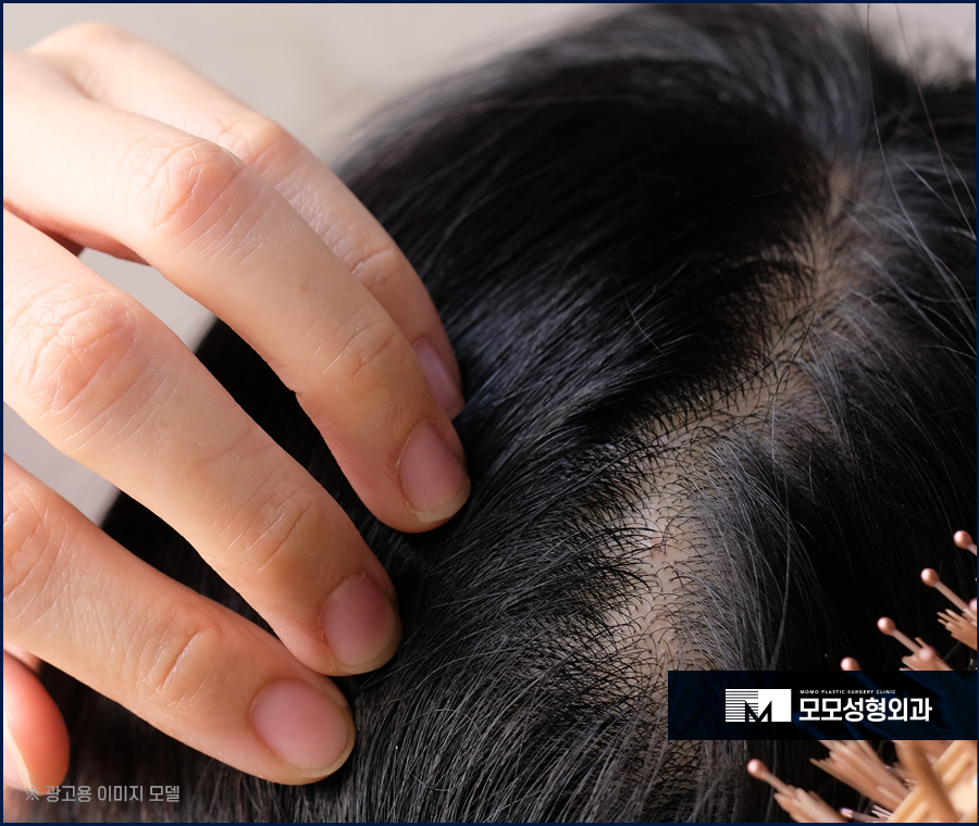 20대 여자 가르마 탈모 빠른 대응이 중요한 이유 관련 이미지 6