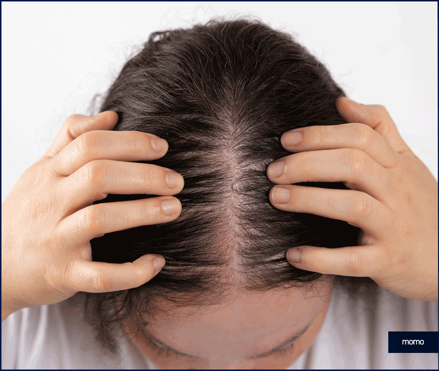 여자 측두부 탈모 아름다운 옆모습을 만드는 방법 관련 이미지 10