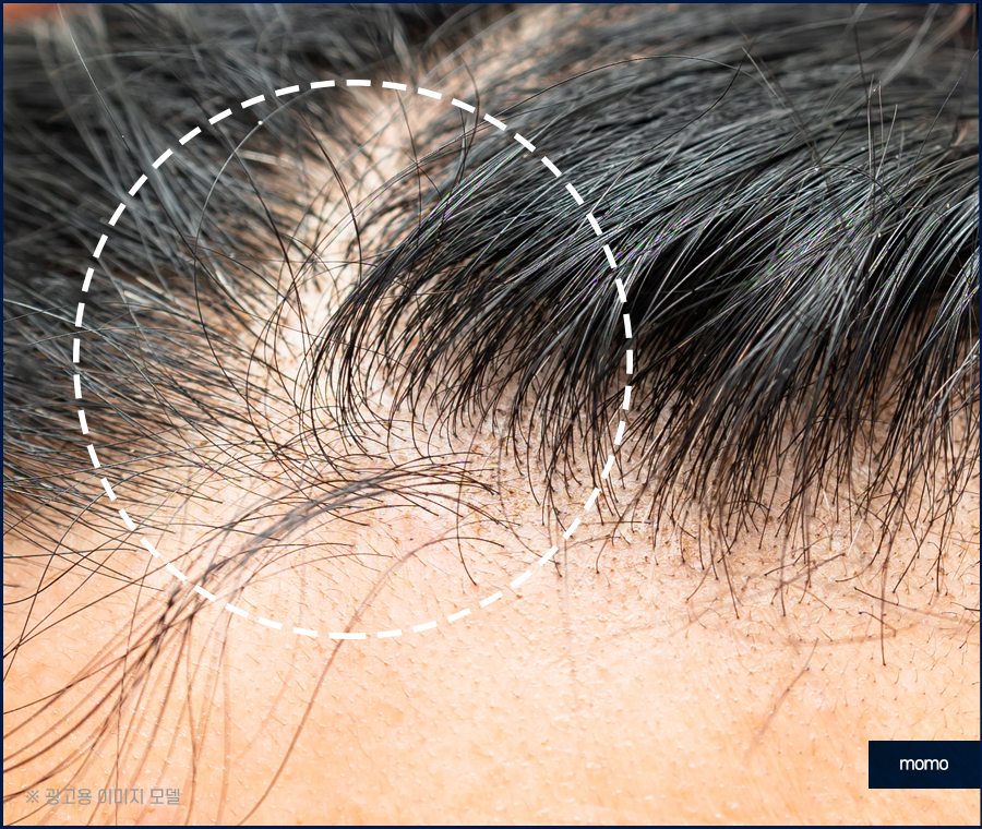 모발이식 생착률 기준짓는 요소들은 무엇일까 관련 이미지 2