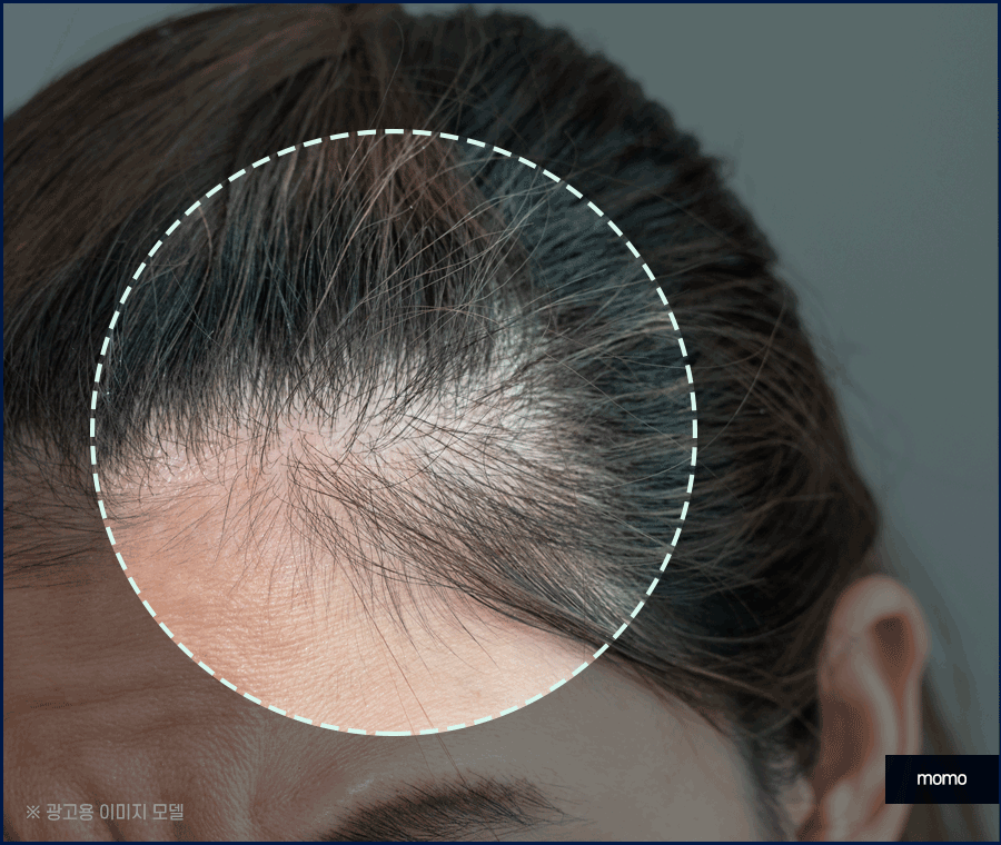 출산후 탈모 자연스럽게 보완하는 방법은 관련 이미지 12