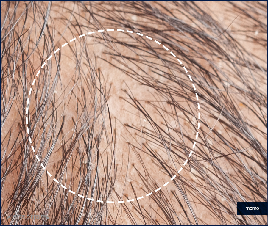 비절개 모발이식 비용 개인차를 고려해서 관련 이미지 8