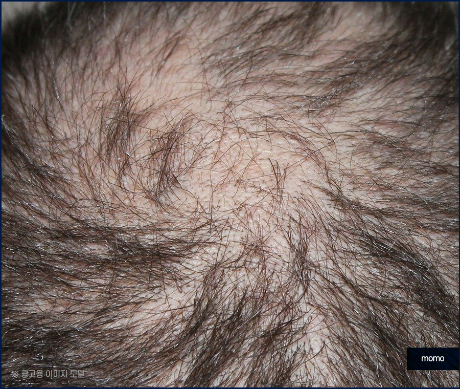 강남 모발이식 정교하게 보완하는 관련 이미지 9