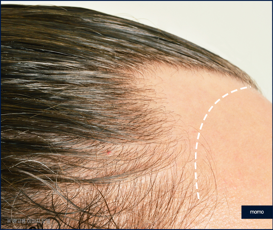 여자 헤어라인 모발이식 외모 자신감을 높이는 관련 이미지 12