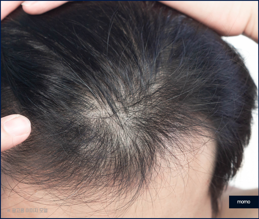 헤어라인모발이식비용 생착률을 높여가면서 관련 이미지 2