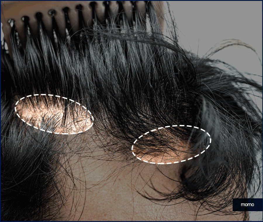 남자헤어라인모발이식 디자인의 중요성 관련 이미지 8