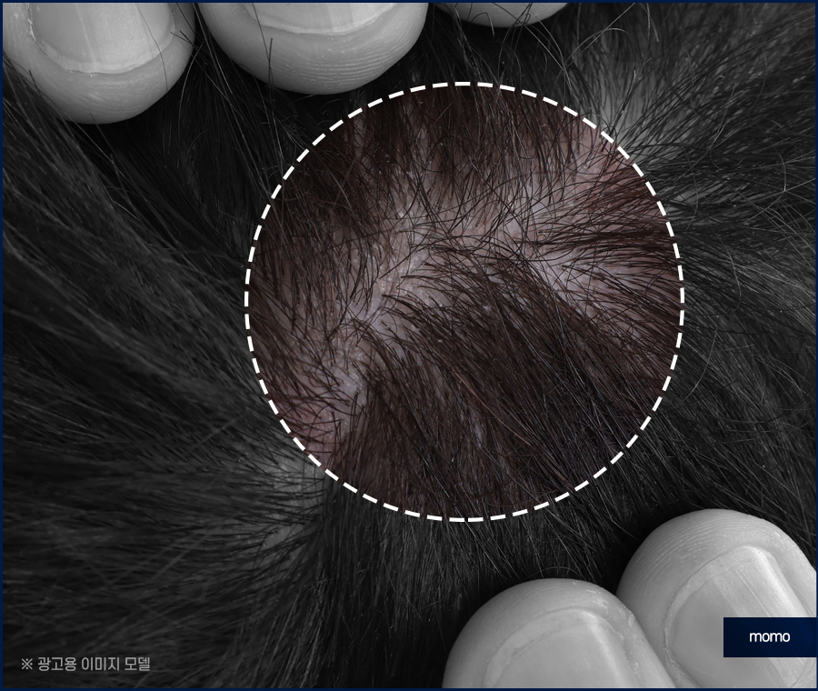 남자 가르마 탈모 고민을 끝내기 위한 방안은 관련 이미지 2