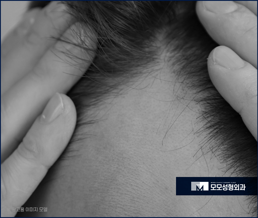 여자 헤어라인 모발이식 부작용 발생 우려를 낮춰야만 관련 이미지 4