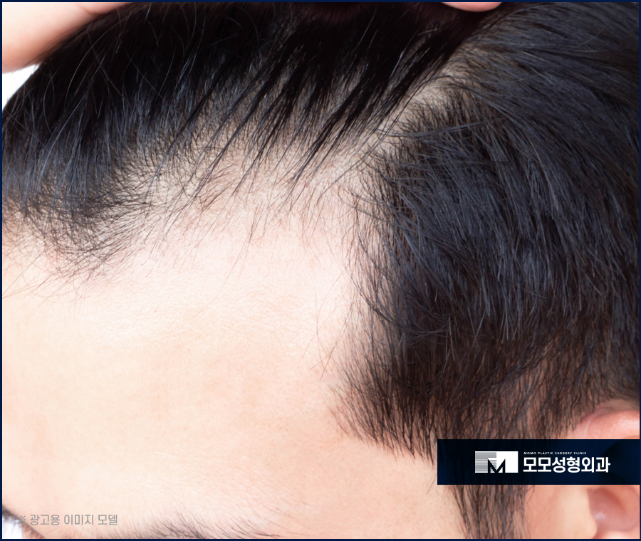 압구정모발이식 외모에 대한 고민을 해결하는 관련 이미지 4