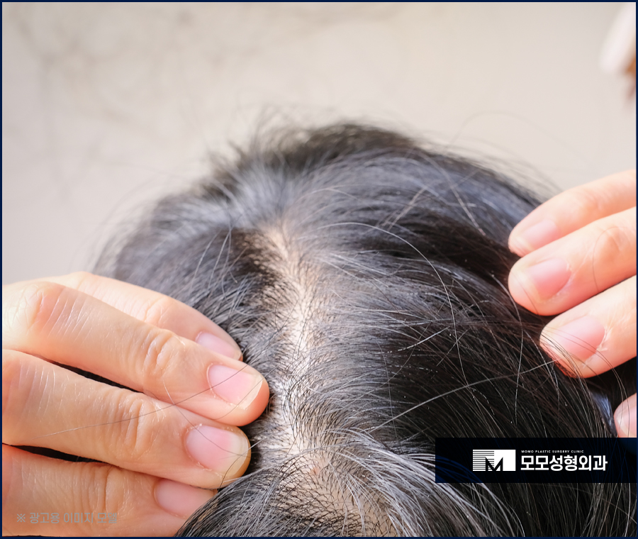 여성 정수리 모발이식 섬세한 집도가 중요한 이유 관련 이미지 3