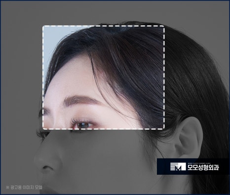 여자비절개모발이식 당당한 이마 라인을 뽐내도록 관련 이미지 3