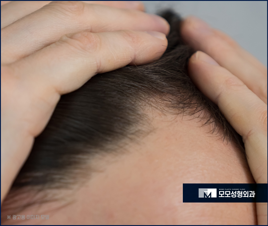 여자엠자탈모 인상까지 변화될 수 있도록 관련 이미지 2