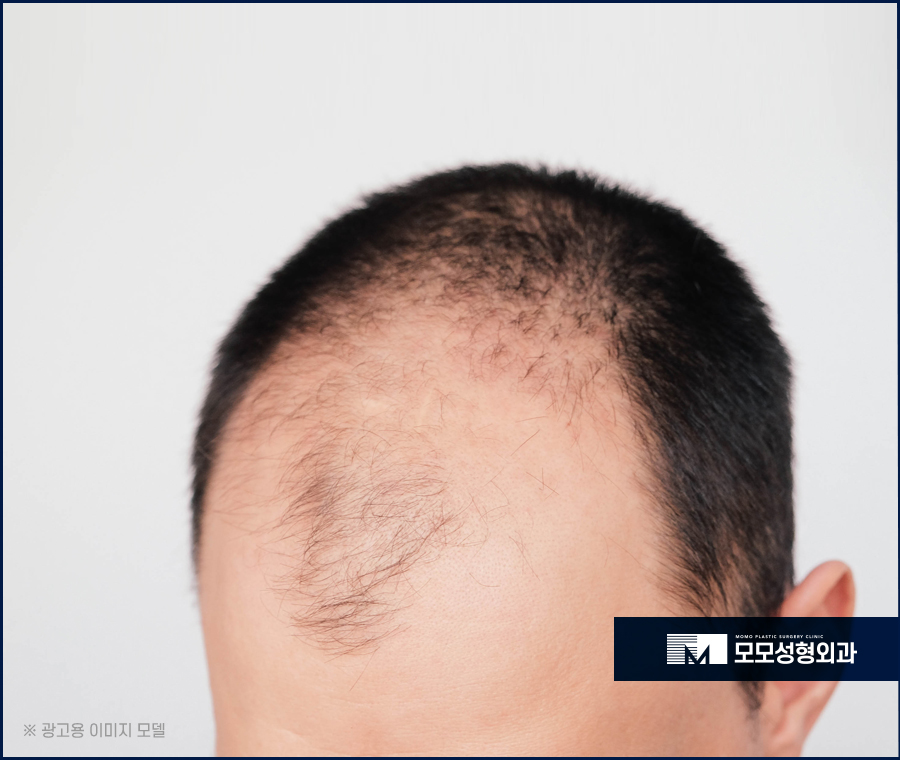 모발이식5000모 얼굴형까지 적절히 유념해서 관련 이미지 2