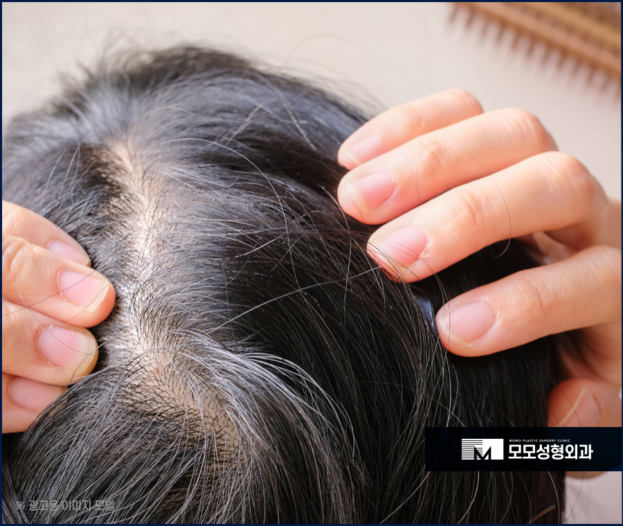 두피모낭염 증상 및 완화를 위한 방법에 대해서 관련 이미지 5