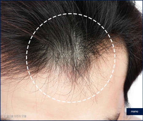 전두부탈모 원인과 시기, 해결 방안까지 관련 이미지 5