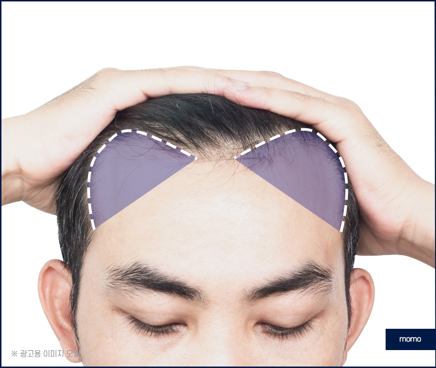 모발이식재수술 원인 파악을 먼저 관련 이미지 4