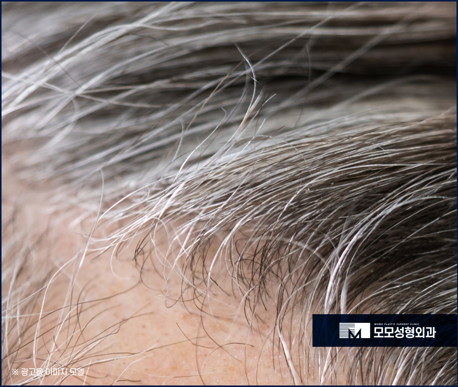 새치나는이유와 처리 방법에 대해 관련 이미지 3