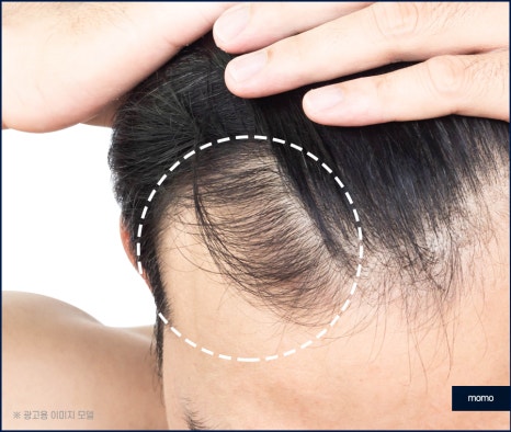강남 모발이식 병원 차이가 나는 이유는 관련 이미지 3