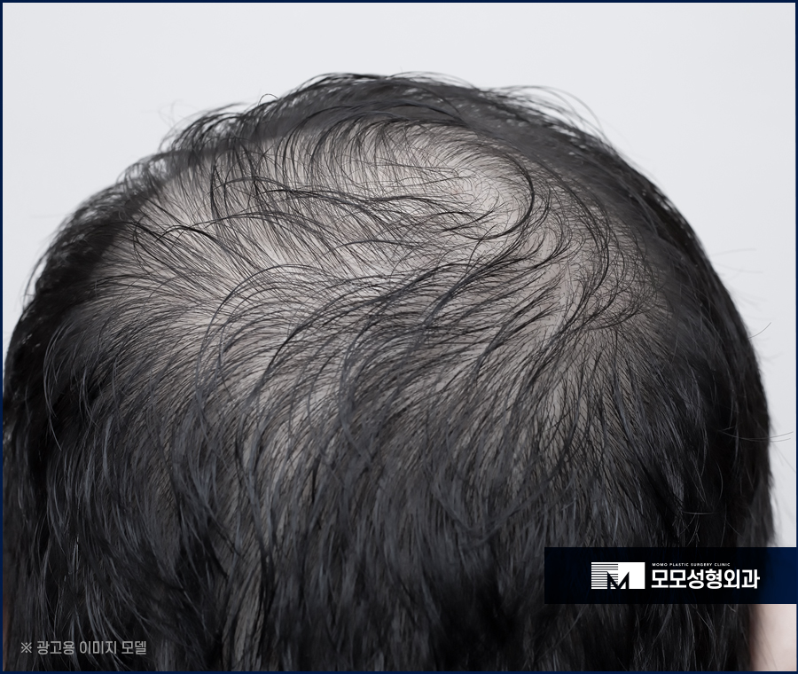 모발이식2000모 자연스럽게 채우는 방향으로 관련 이미지 2