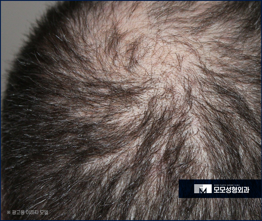 절개모발이식흉터 정도와 흔적이 싫은 상황이라면 관련 이미지 2