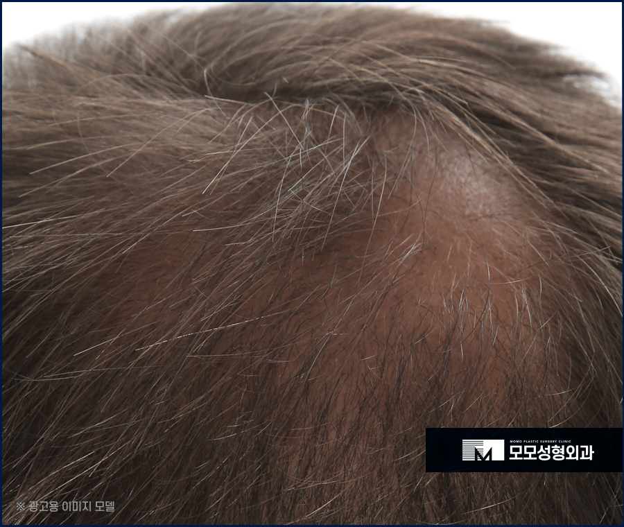 서울 모발이식 오랜 고민을 이겨내기 위한 선택 관련 이미지 7