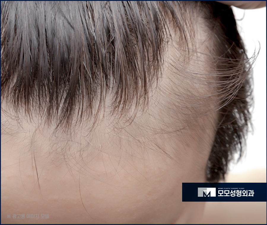 마이크로컷 비절개 모발이식 자연스러운 이후 외모를 관련 이미지 4