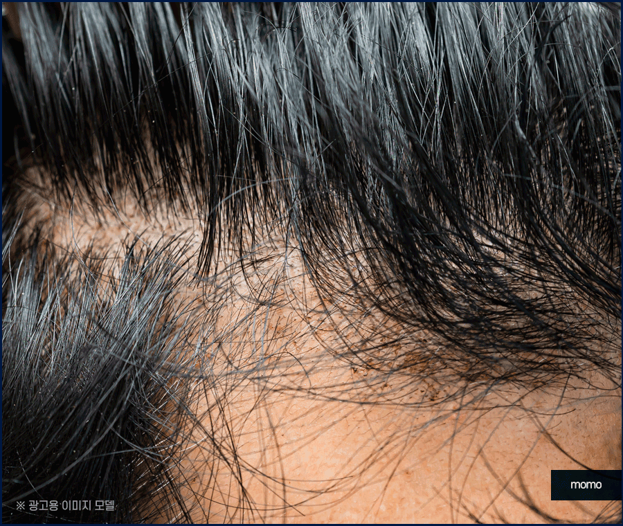 강남 탈모 병원 원인 파악부터 철저하게 시작하는 곳 관련 이미지 5