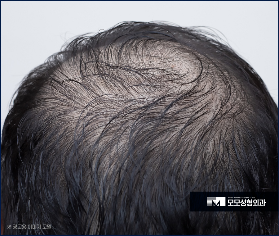 맞춤모발이식 풍성한 결과를 만드는 관련 이미지 3