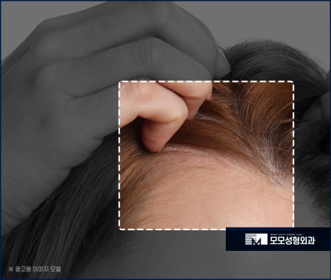 여자비절개모발이식 당당한 이마 라인을 뽐내도록 관련 이미지 2