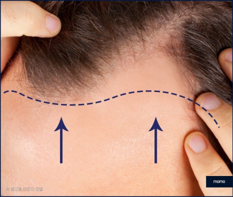 전두부탈모 원인과 시기, 해결 방안까지 관련 이미지 3