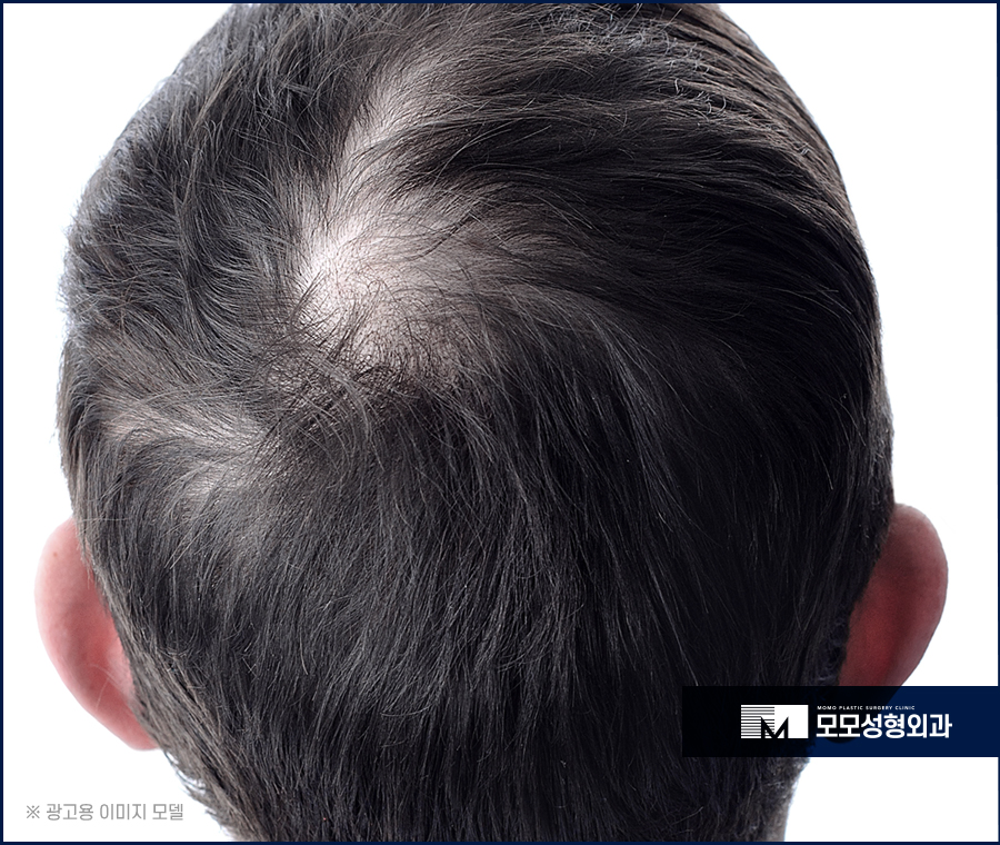 무삭발모발이식 신속한 회복으로 관련 이미지 3