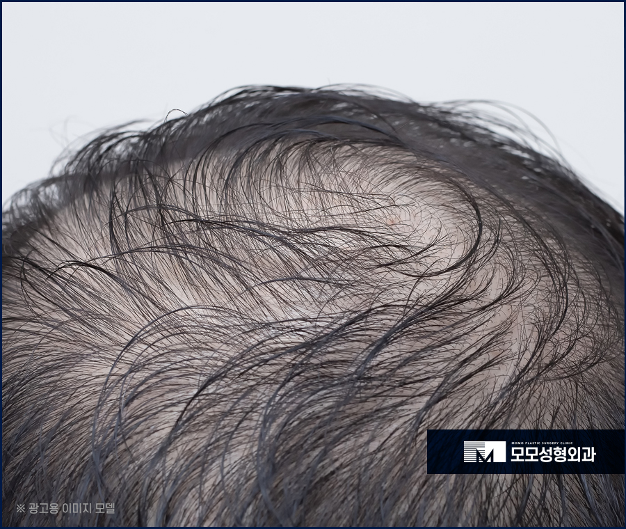 비절개모발이식통증 정도와 수준에 대해 관련 이미지 4