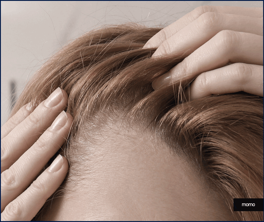 여자 모발이식 헤어라인 교정이 필요하다면 관련 이미지 13