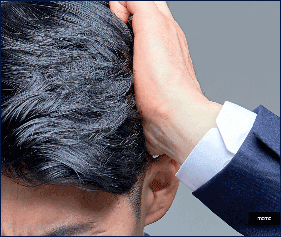 m자탈모병원 모발이식 고민이신 분들이라면 필독 관련 이미지 9