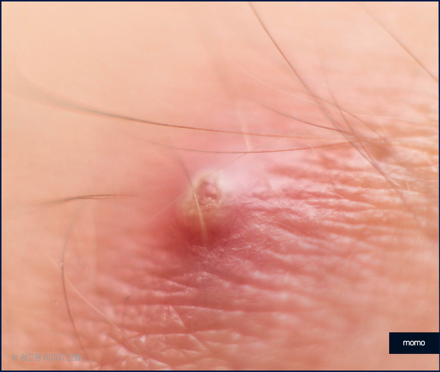 두피 종기 원인 및 치료, 관리 방법 관련 이미지 10