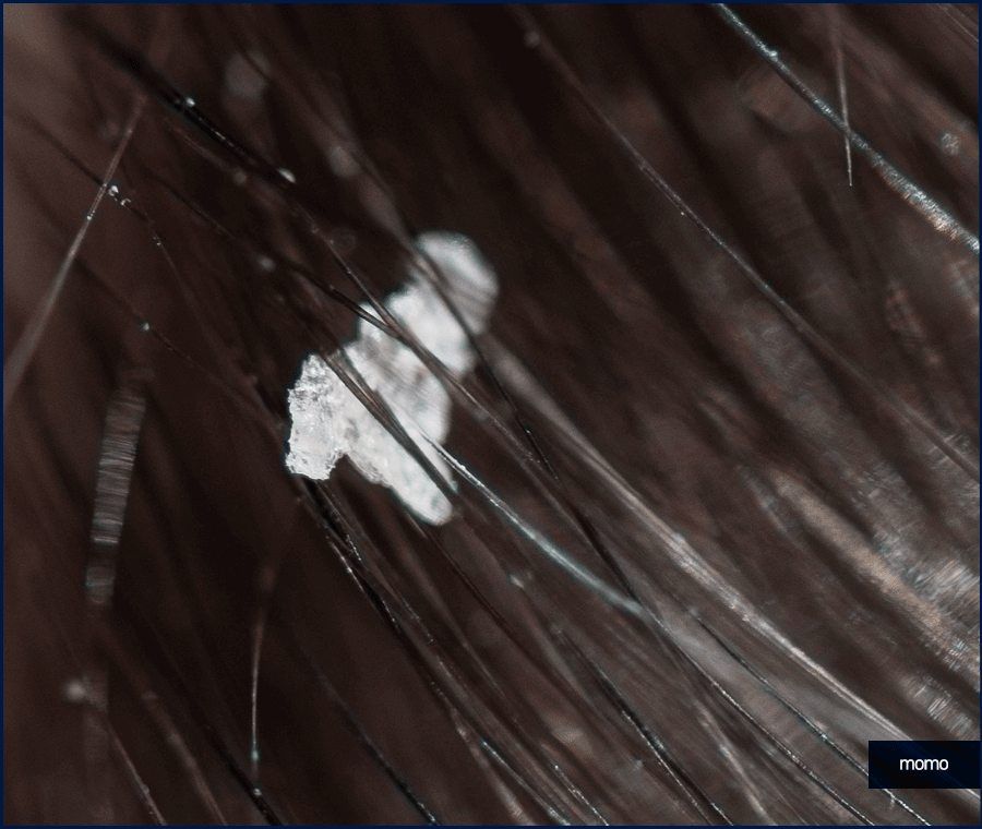 머리 감아도 비듬이 나타나는 이유 및 제거 팁 관련 이미지 4