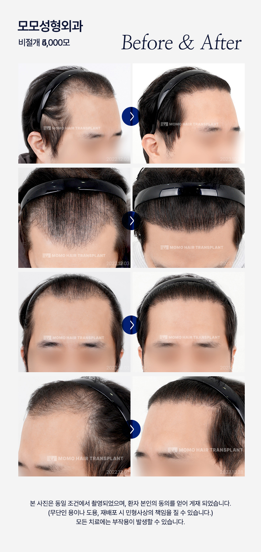 남자 모발이식 비용, 방법까지 꼼꼼히 확인하세요! 관련 이미지 14