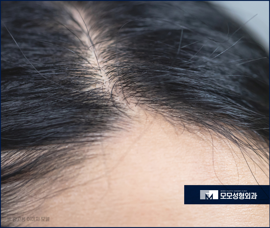 헤어라인 교정 비용 바라던 예후를 만들기 위한 관련 이미지 2