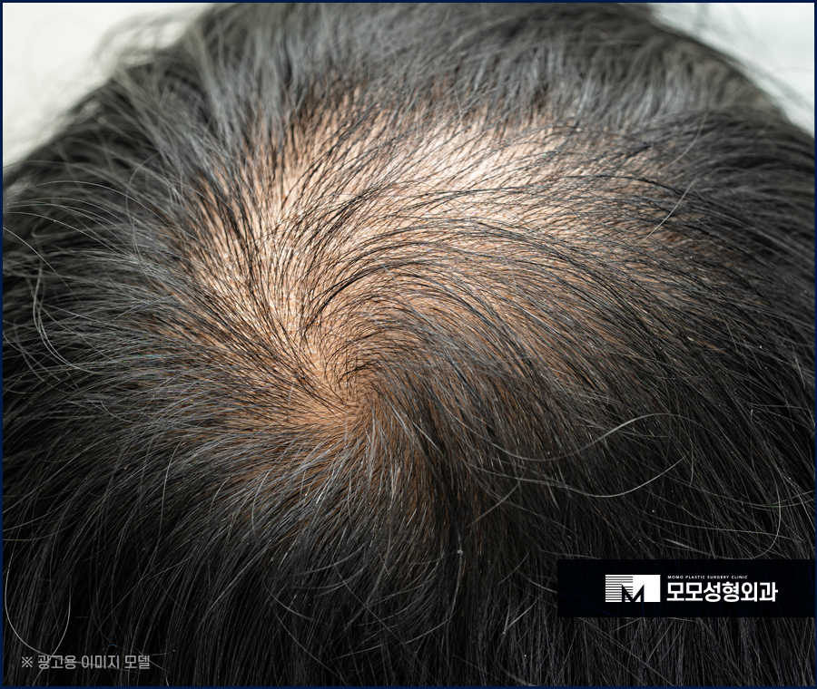 30대 정수리 탈모 초기 증상부터 대응 방법까지 관련 이미지 2