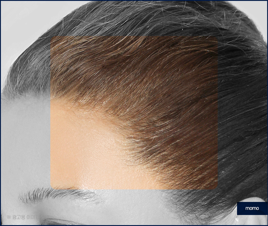 여자 M자 탈모 자연스럽게 채워가는 관련 이미지 7
