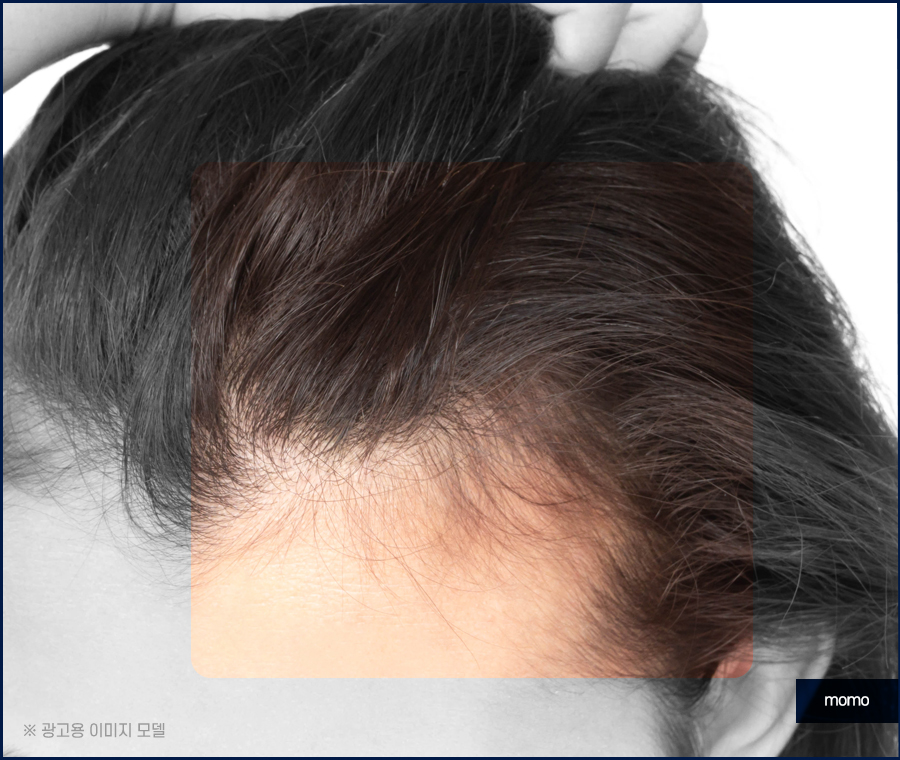 여자 M자 탈모 자연스럽게 채워가는 관련 이미지 2
