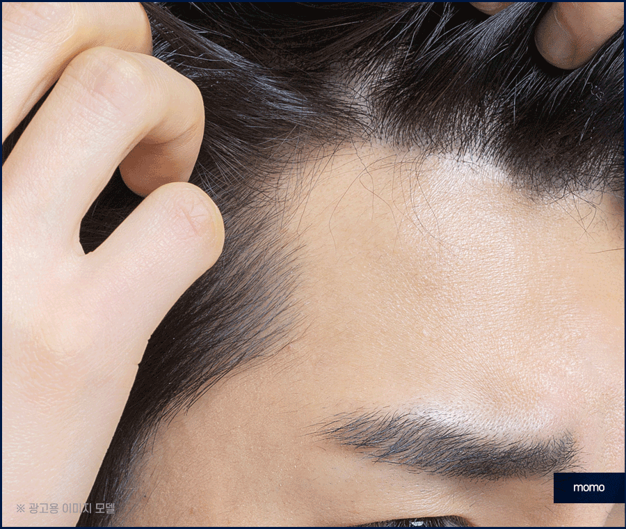 압구정 모발이식 병원 찾고 있다면 꼭 확인하세요 관련 이미지 4